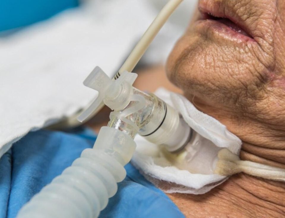 Balloon Dilation for Subglottic and Tracheal Stenosis